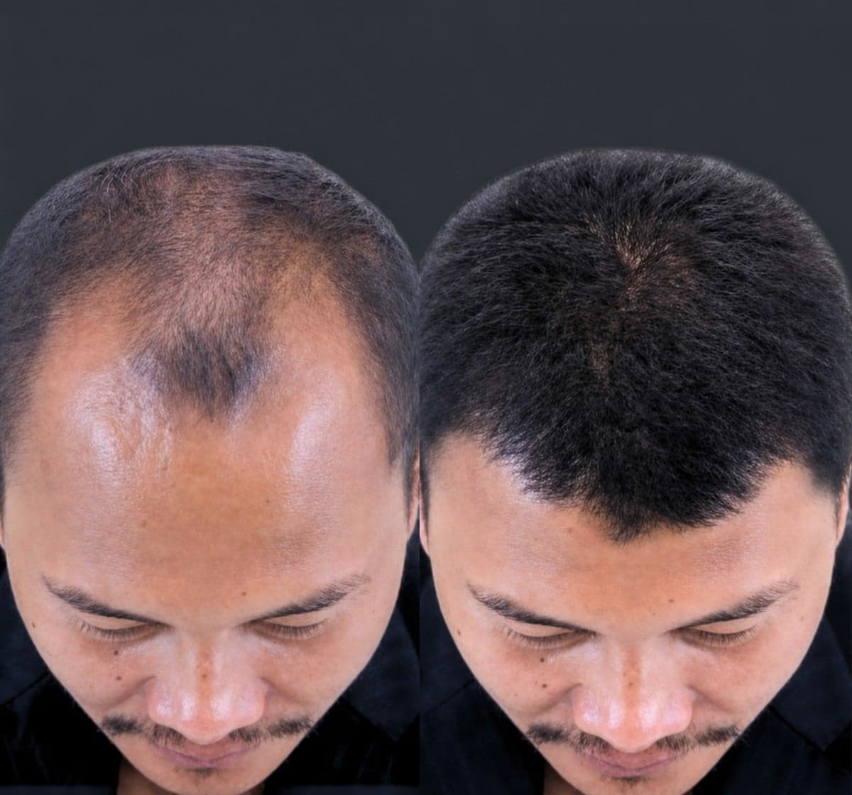 DHI hair transplant