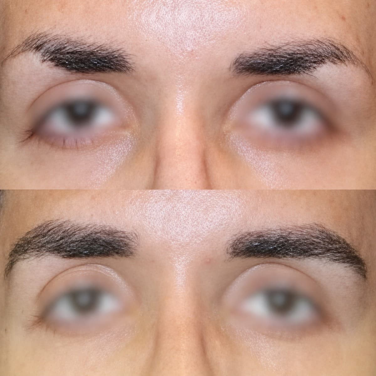 eyebrow transplantation