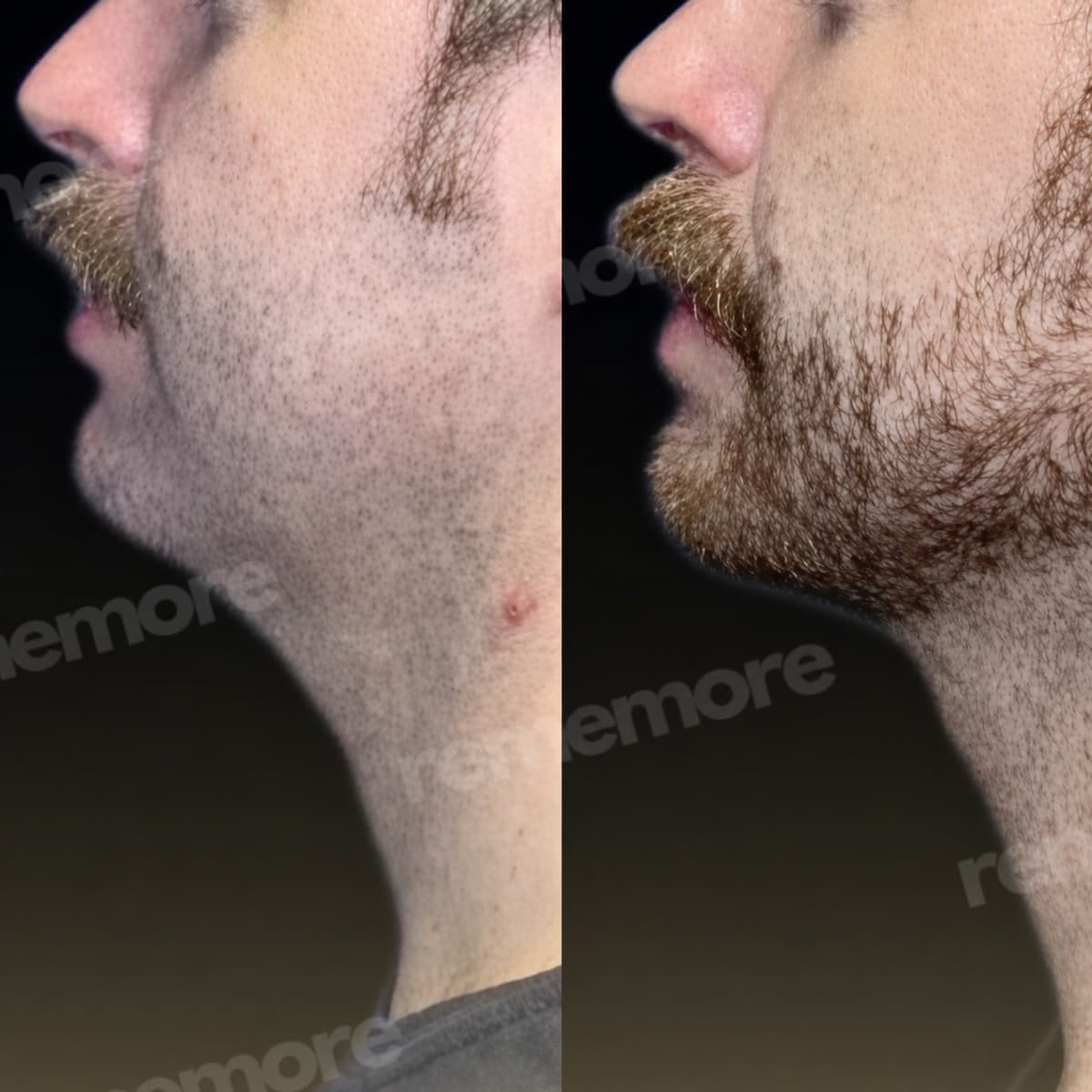 jaw shaping