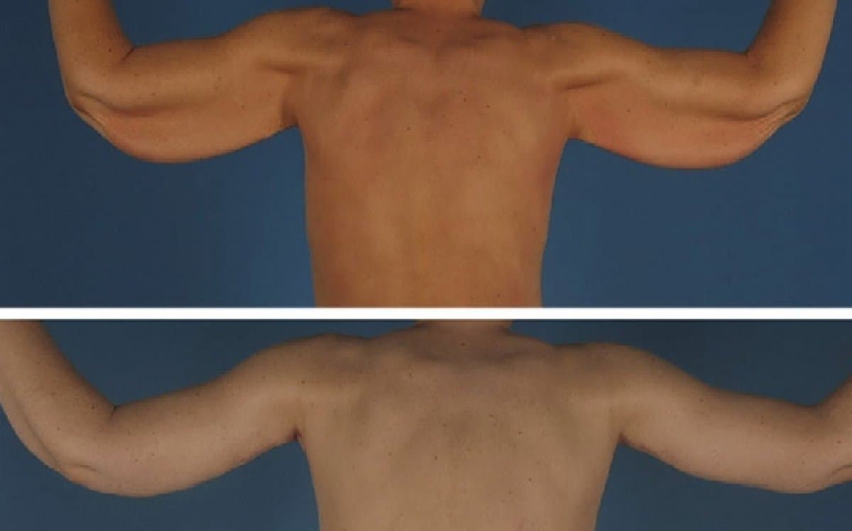 upper arm liposuction