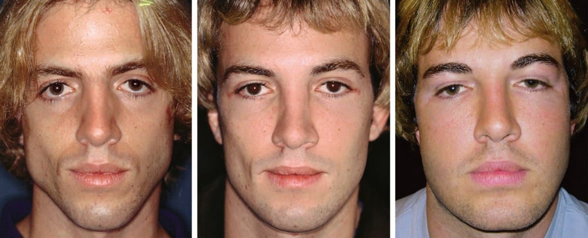 chin implant