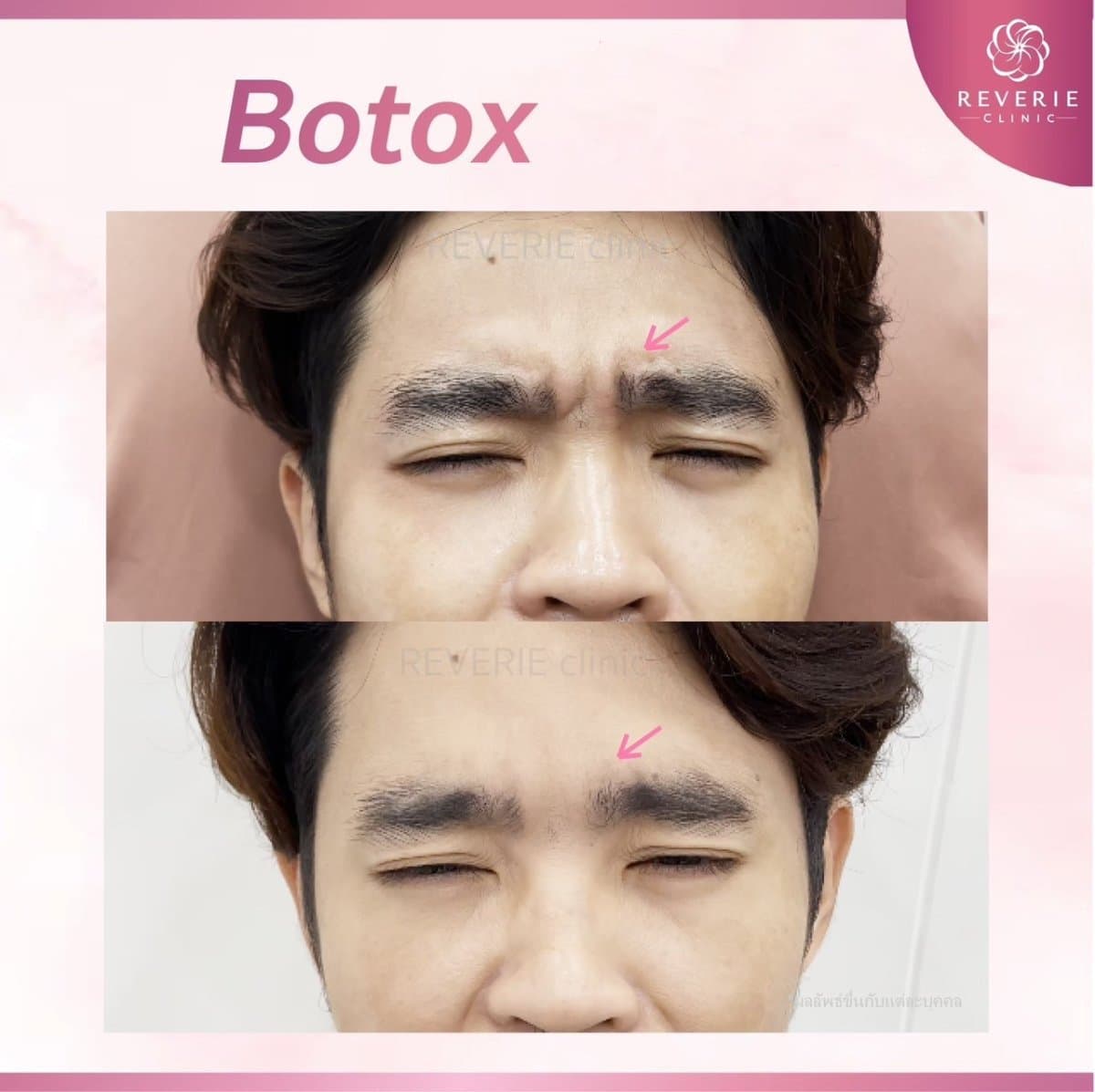Botox injections