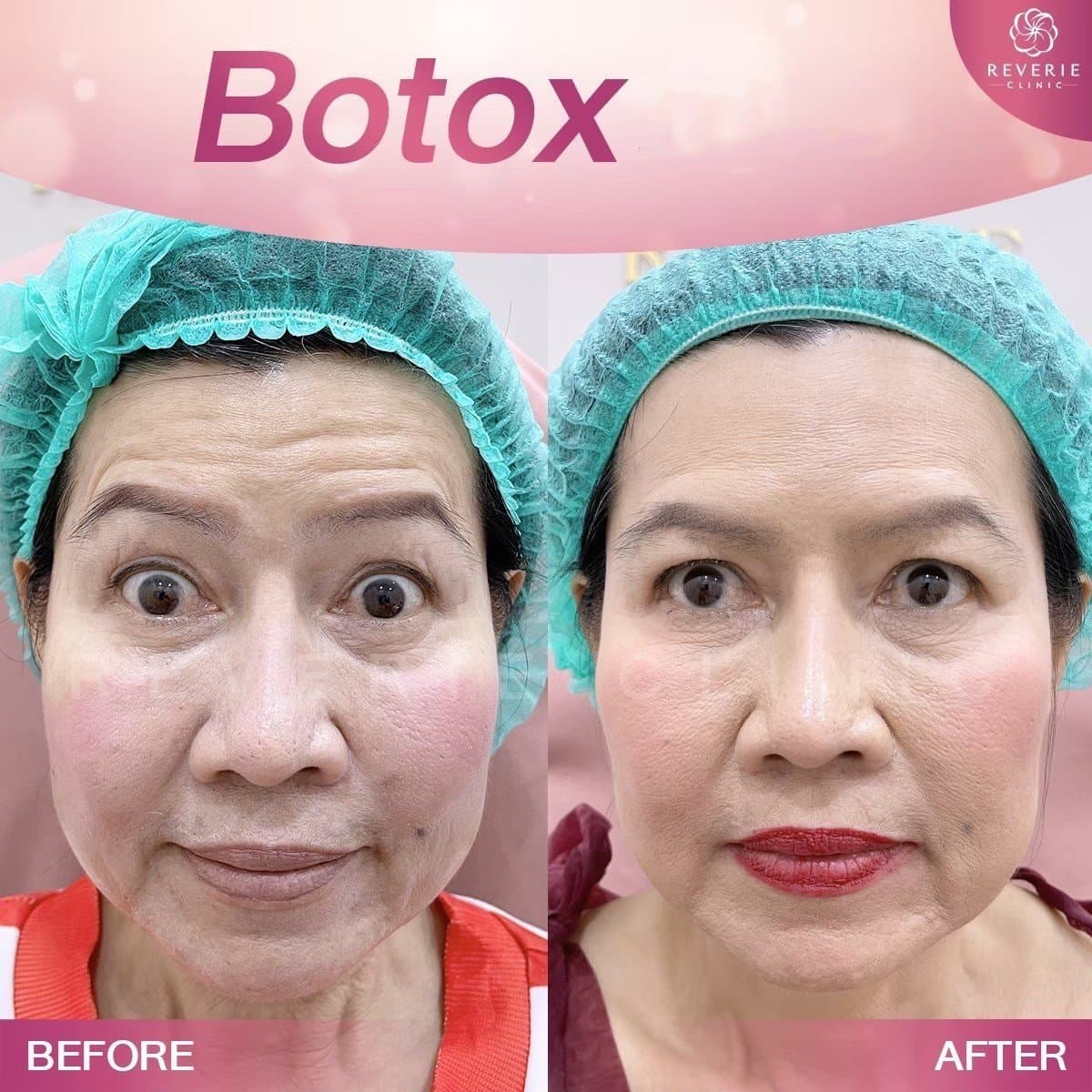 Botox for forehead
