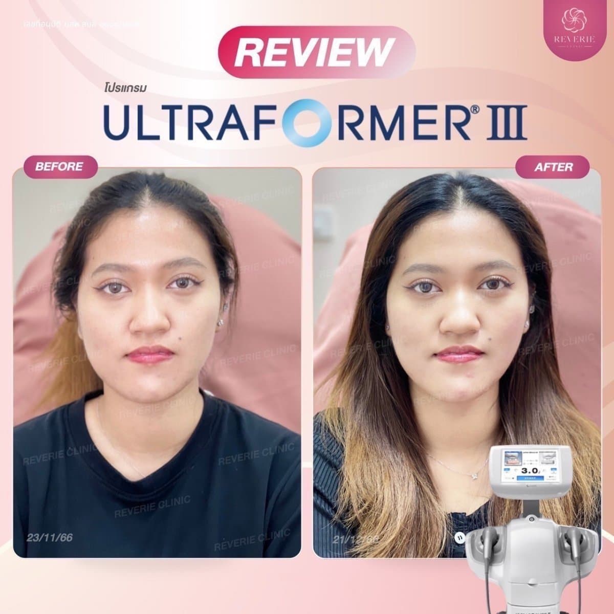 nonsurgical facelift
