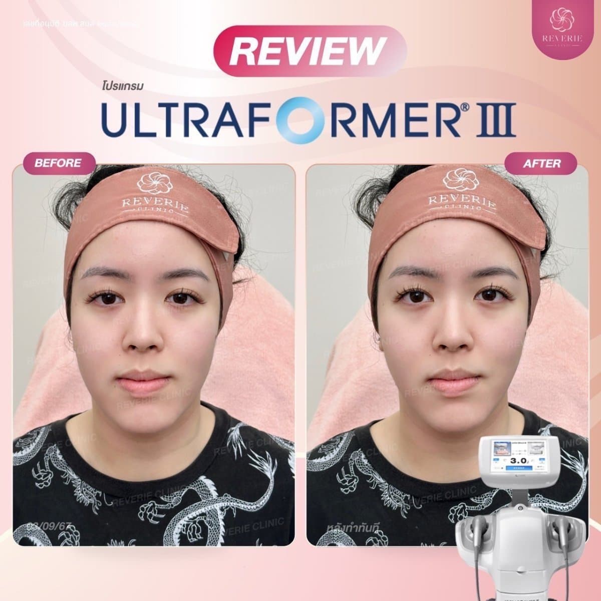 nonsurgical facelift