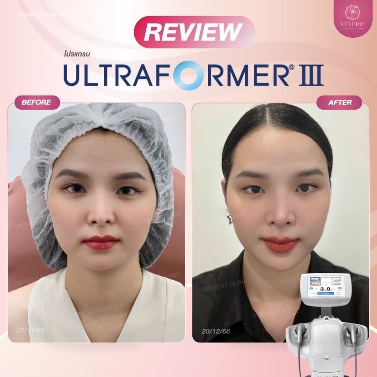 nonsurgical facelift