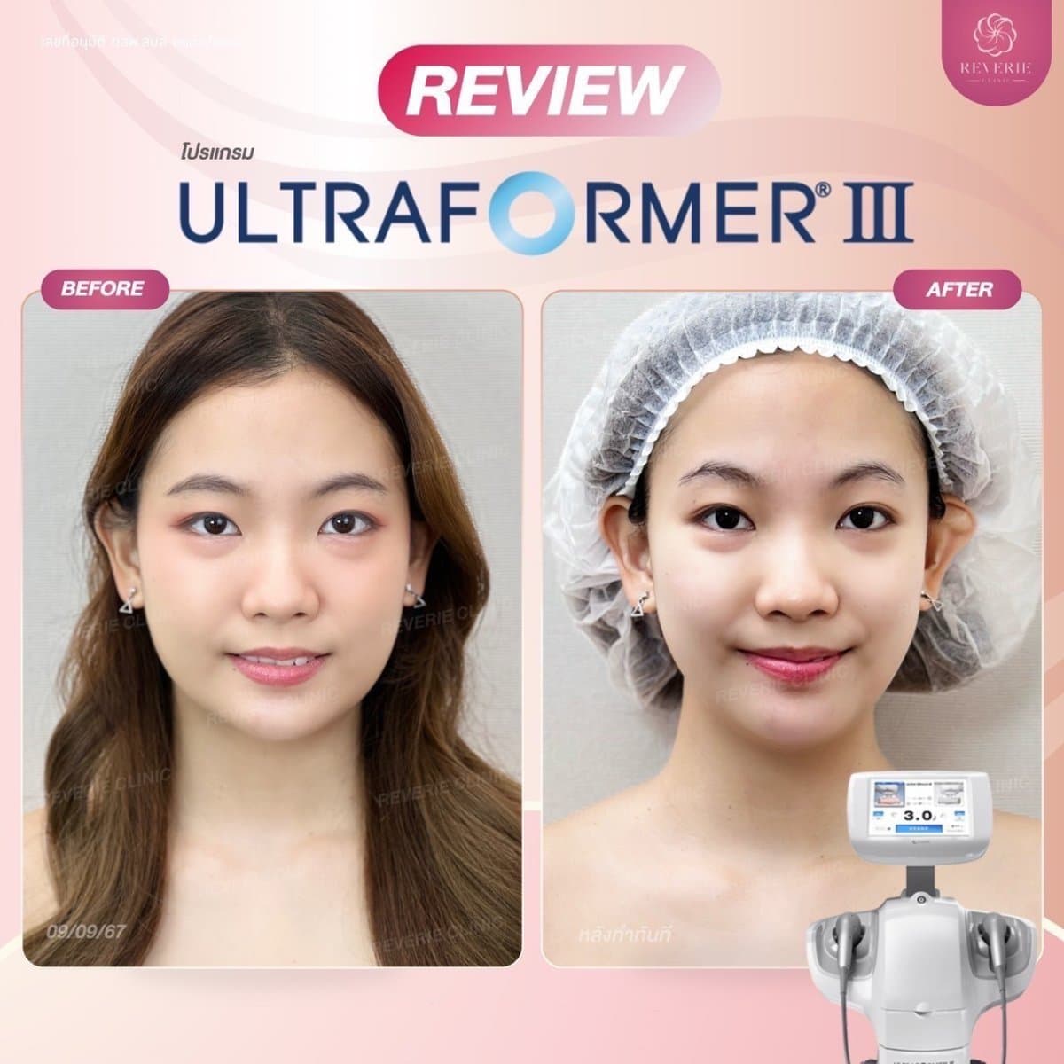 nonsurgical facelift