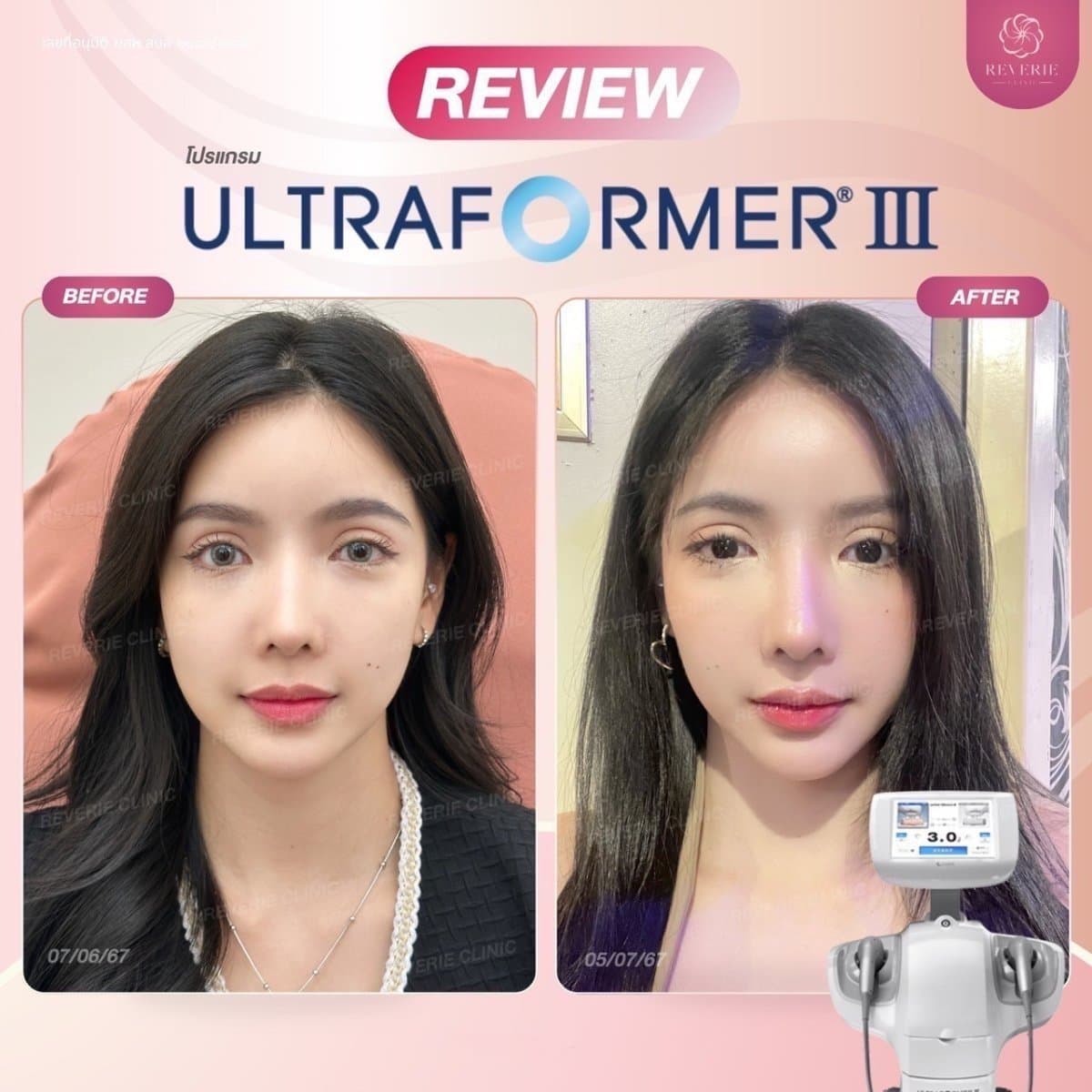 nonsurgical facelift