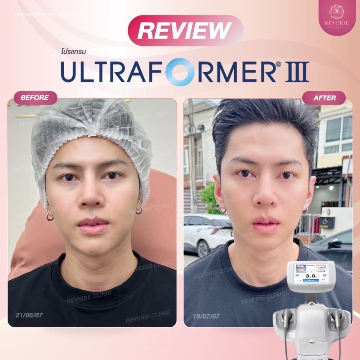 nonsurgical facelift