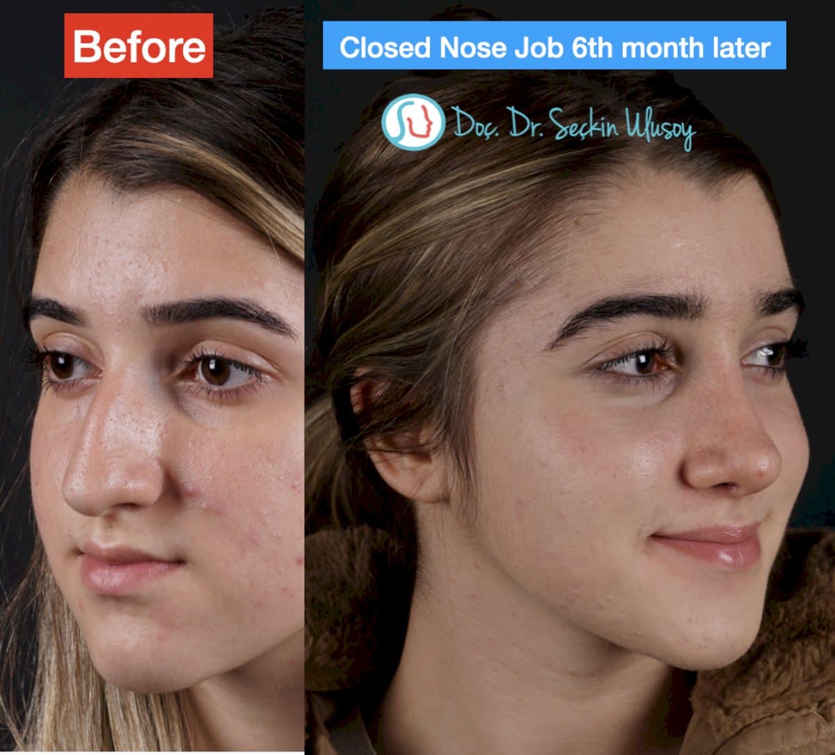 closed rhinoplasty