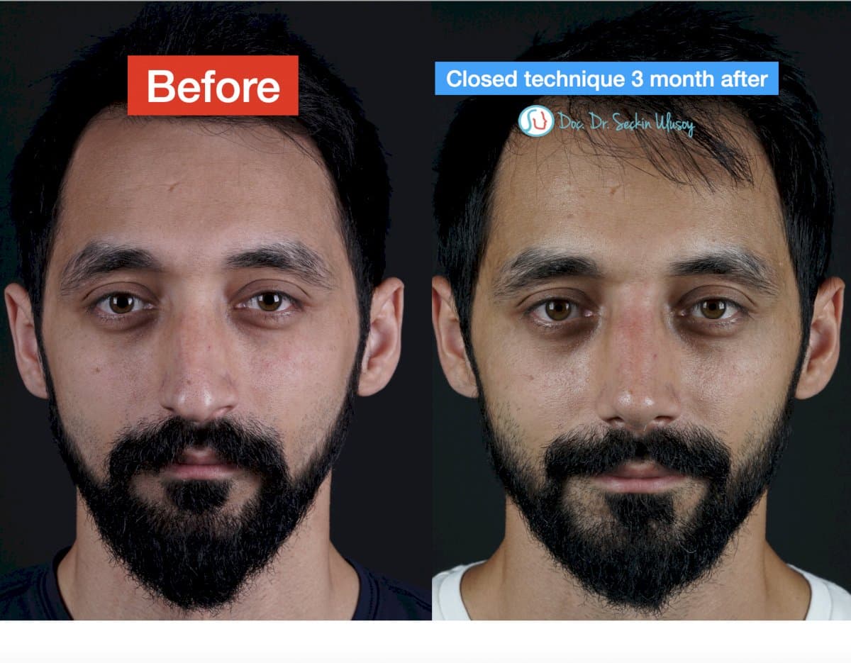 closed rhinoplasty