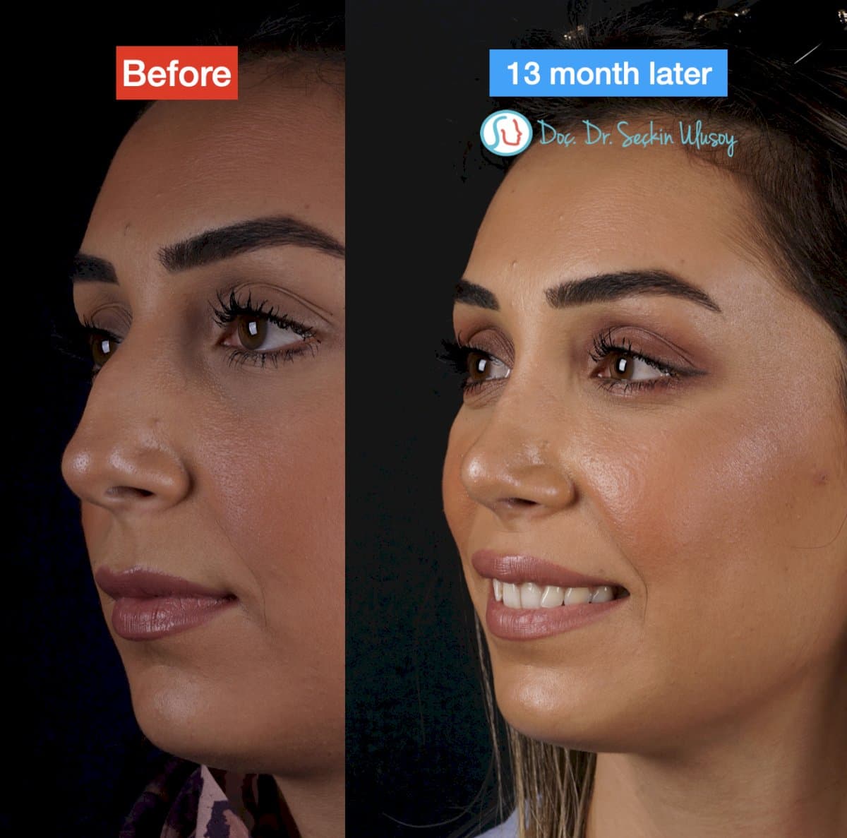 rhinoplasty