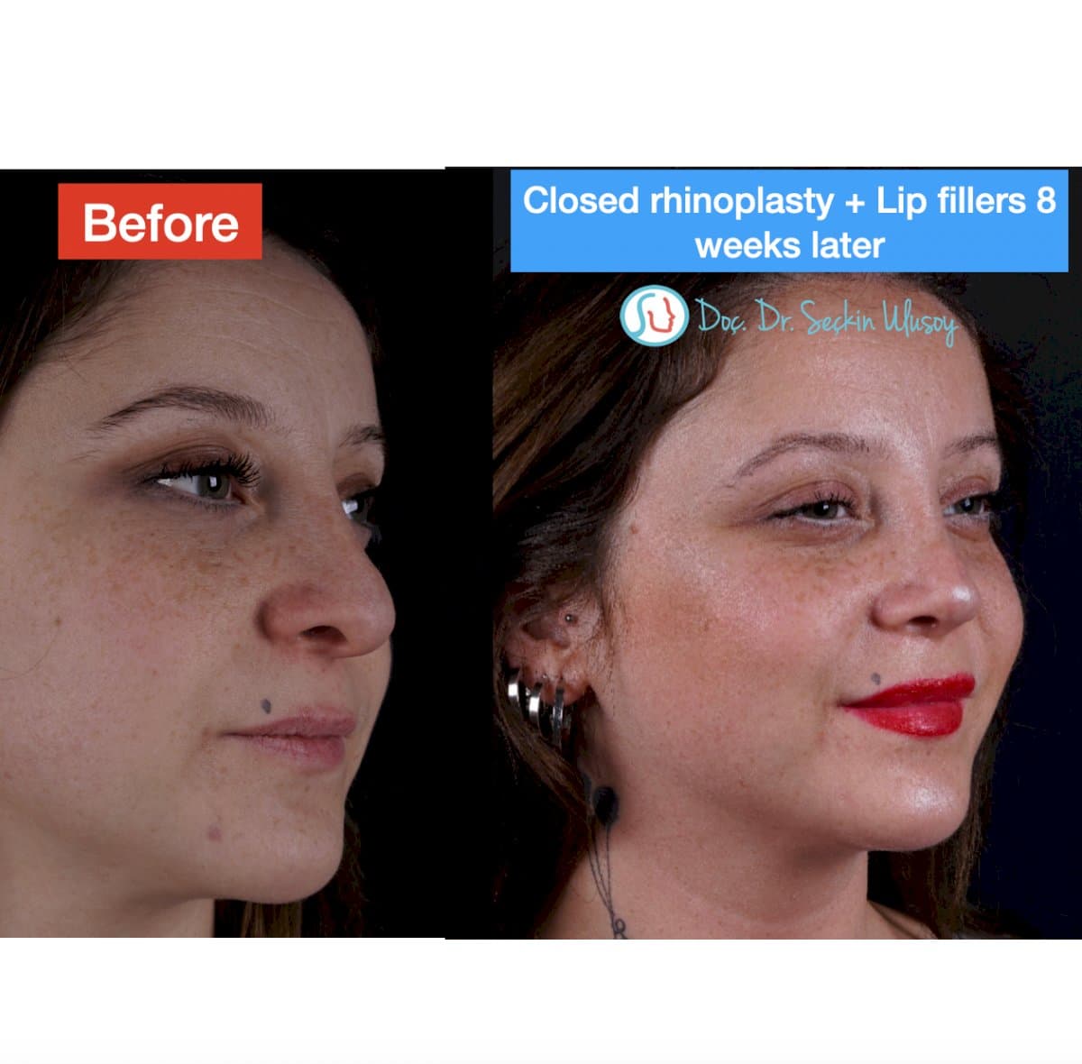 closed rhinoplasty and lip fillers