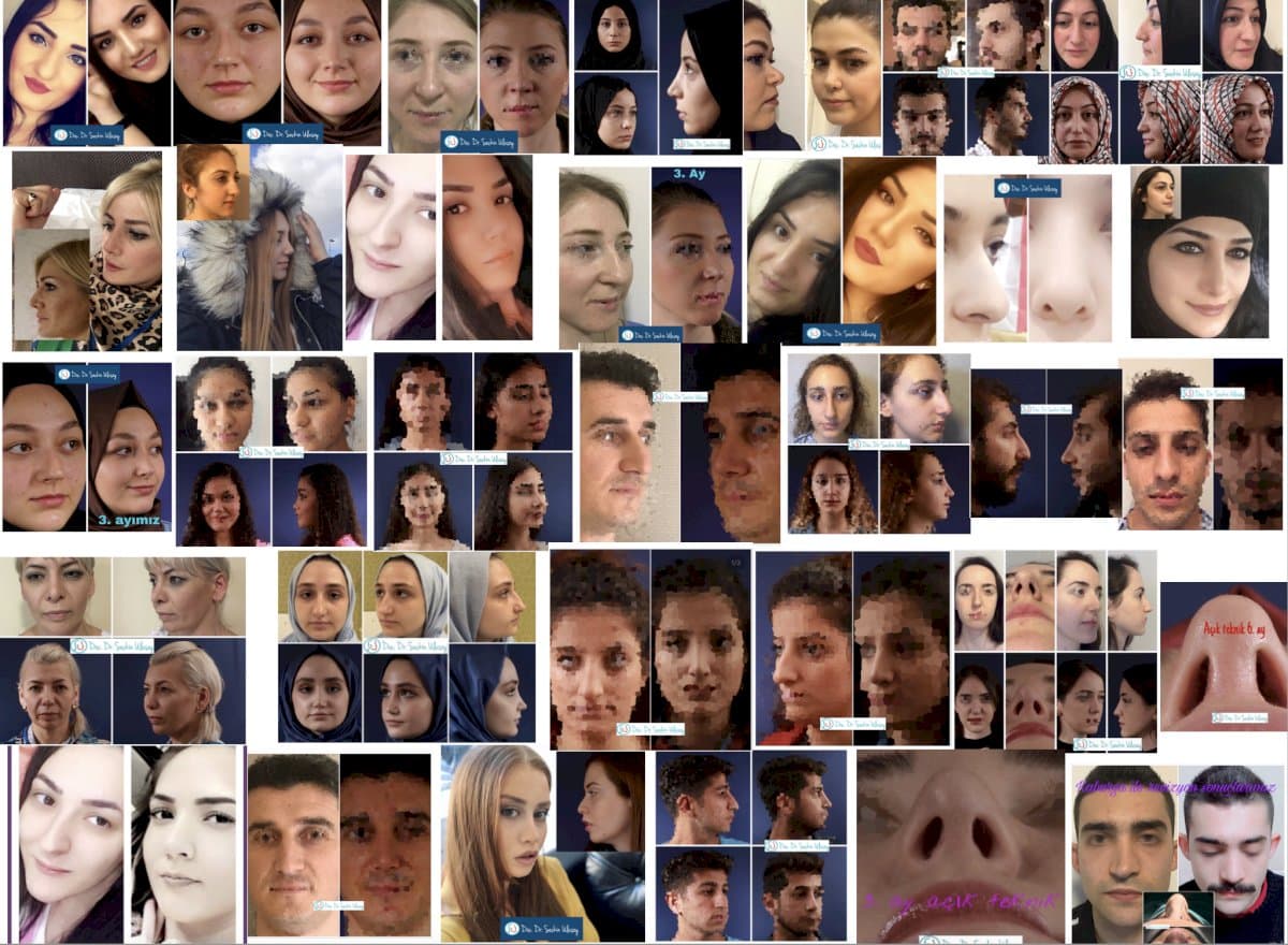 rhinoplasty