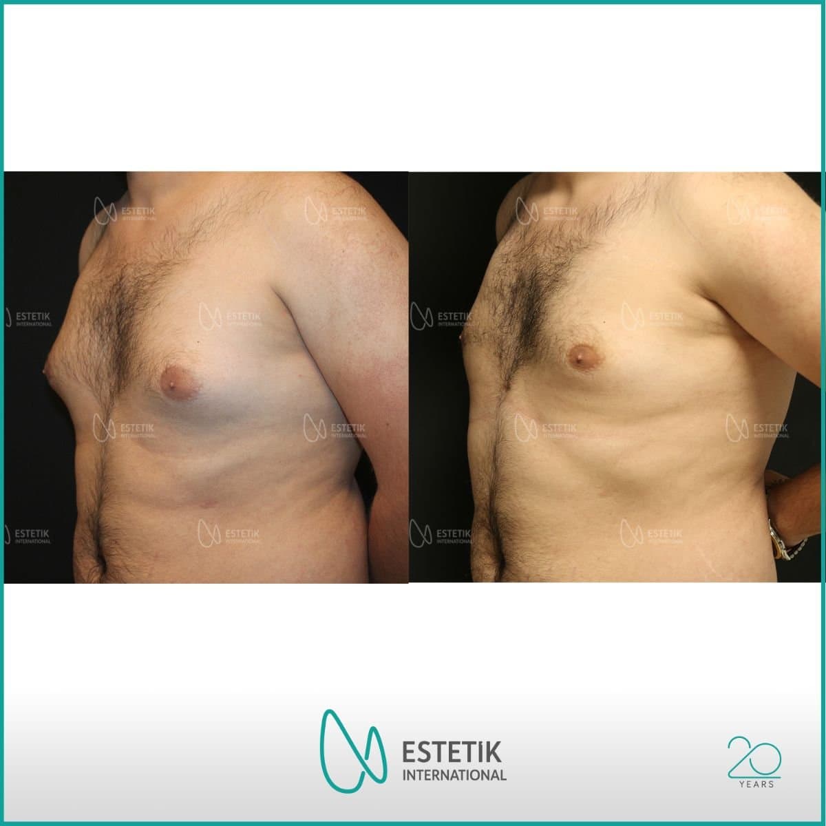 gynecomastia surgery