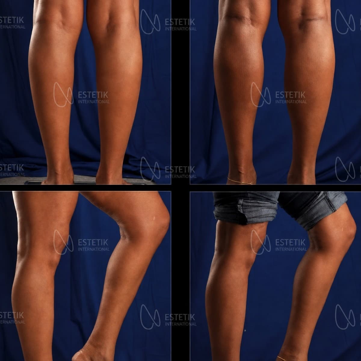 calf implants