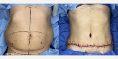 Case 2 - 39 year old man treated with Tummy Tuck