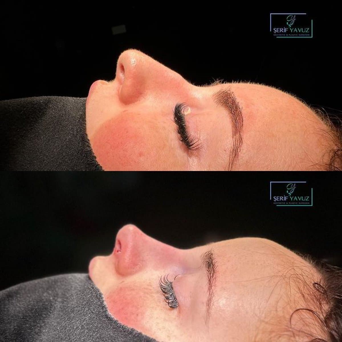 rhinoplasty