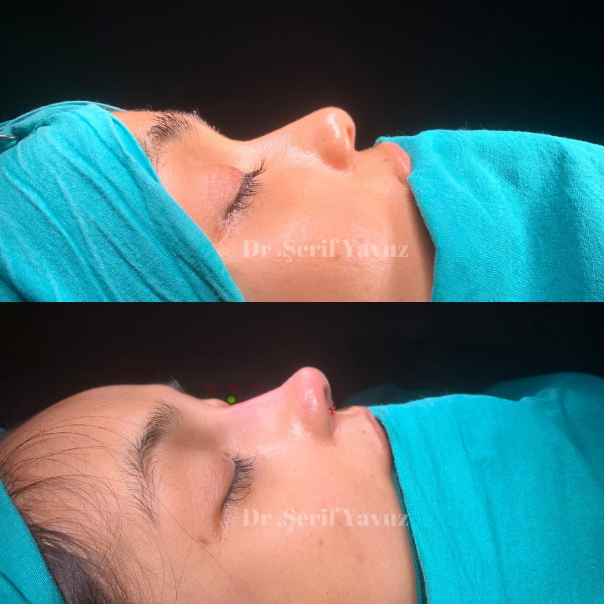 rhinoplasty