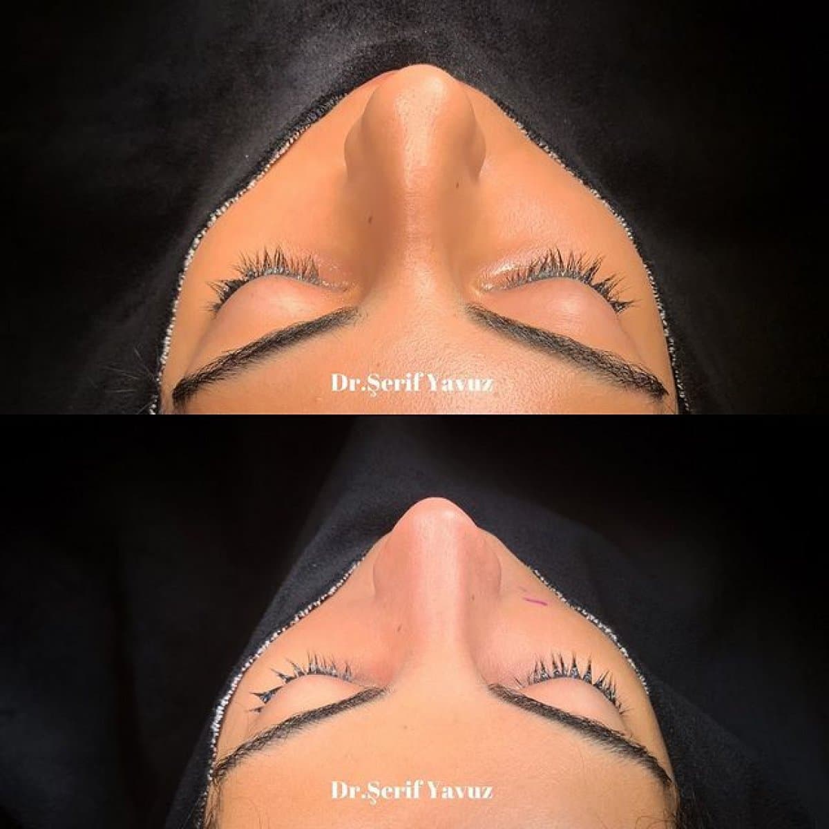 rhinoplasty