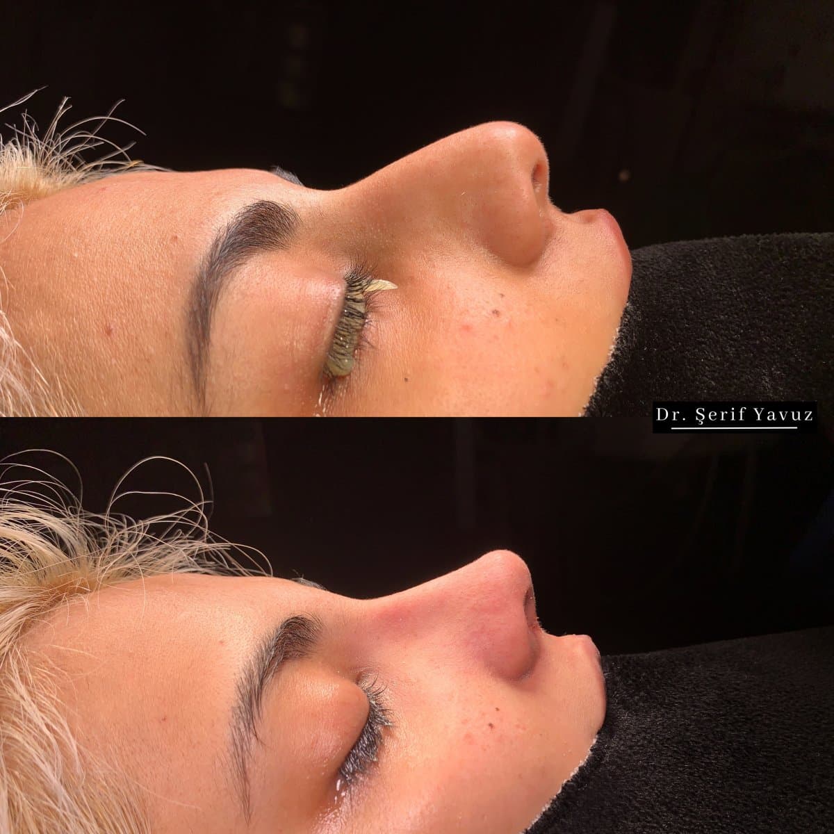 rhinoplasty