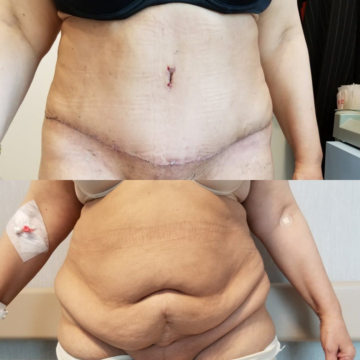 tummy tuck
