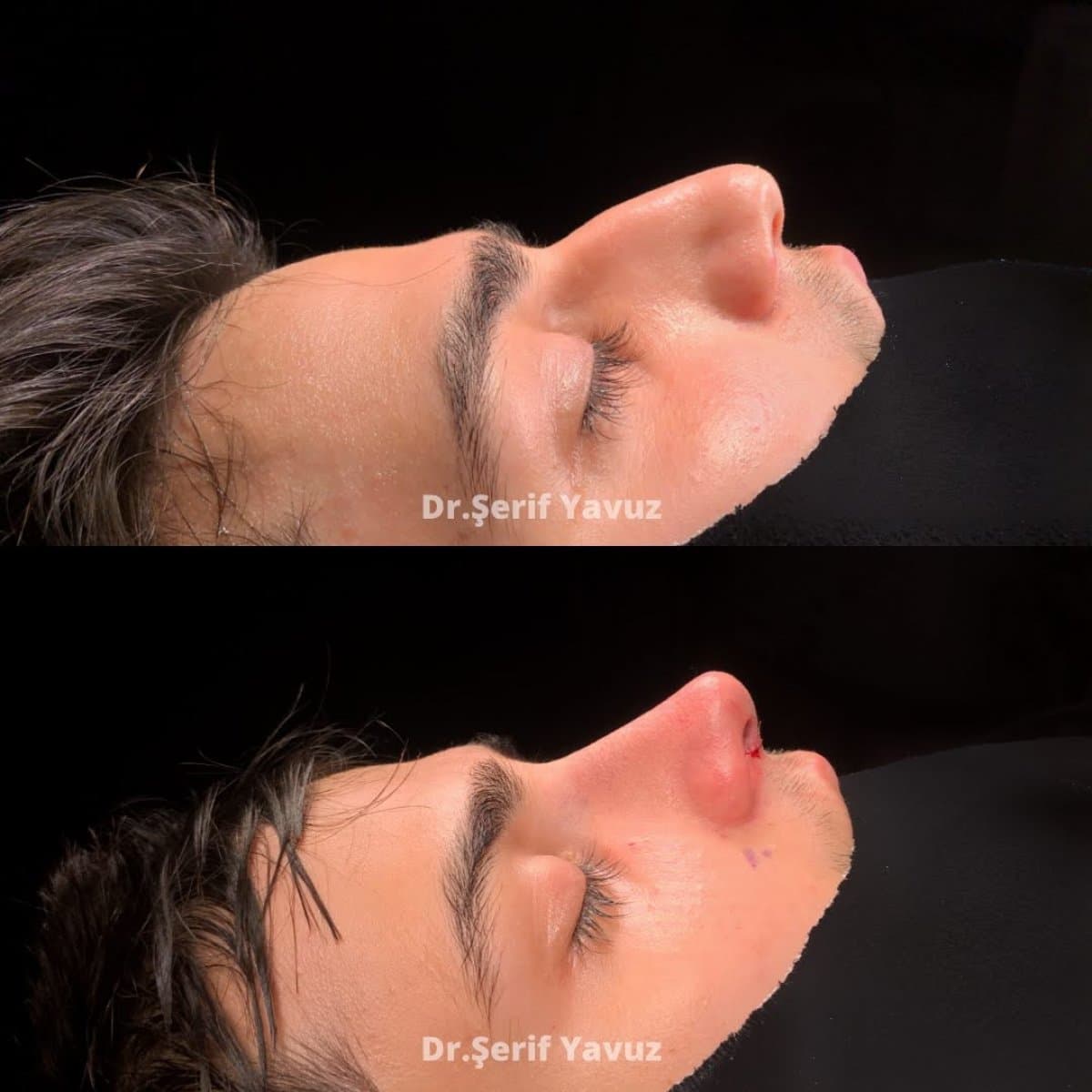 rhinoplasty