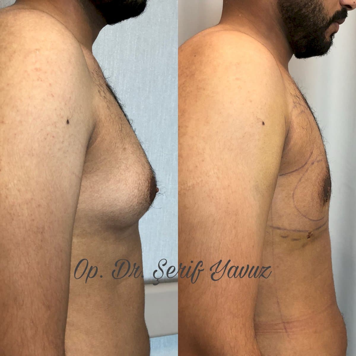 gynecomastia Vaser liposuction