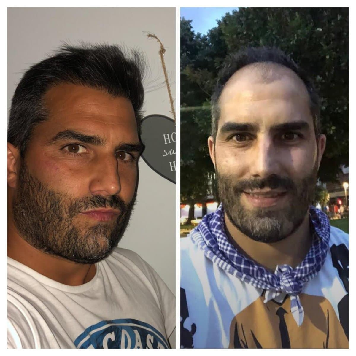 hair transplant