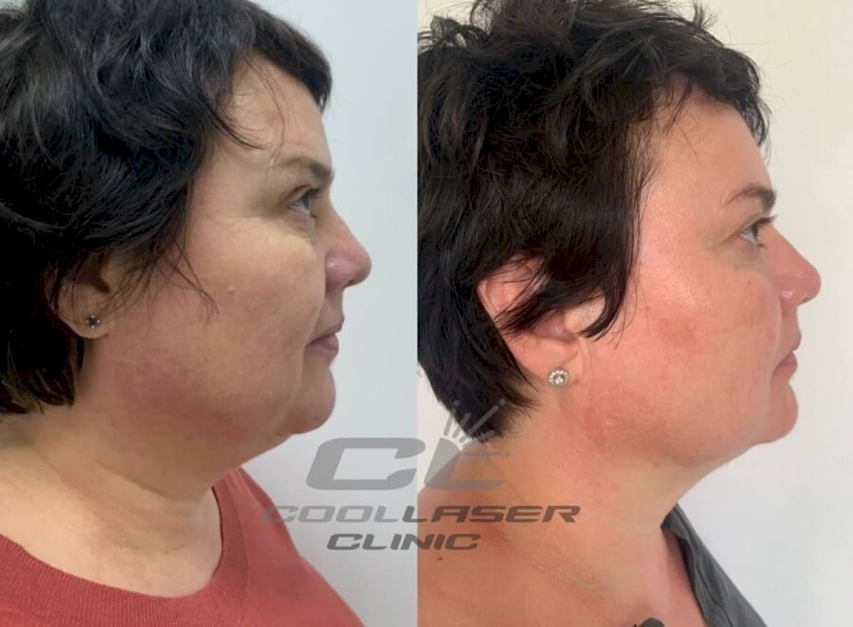 liposuction