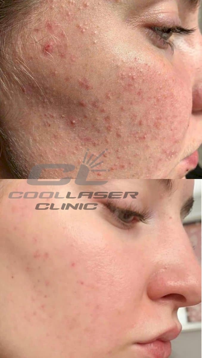 acne scar treatment