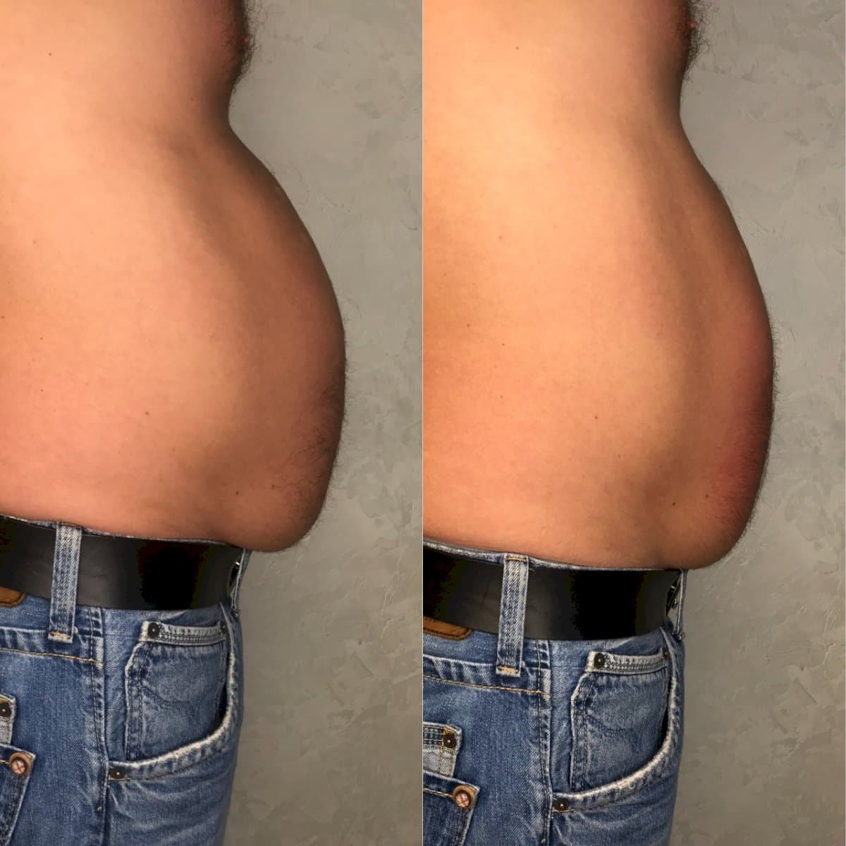 abdominal liposuction