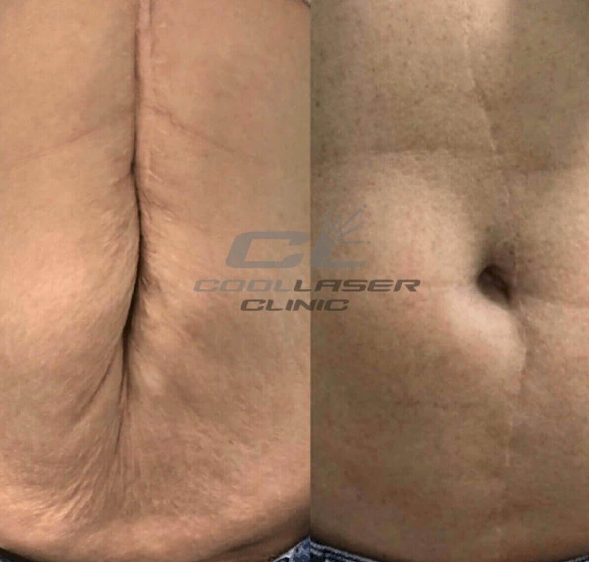laser skin resurfacing