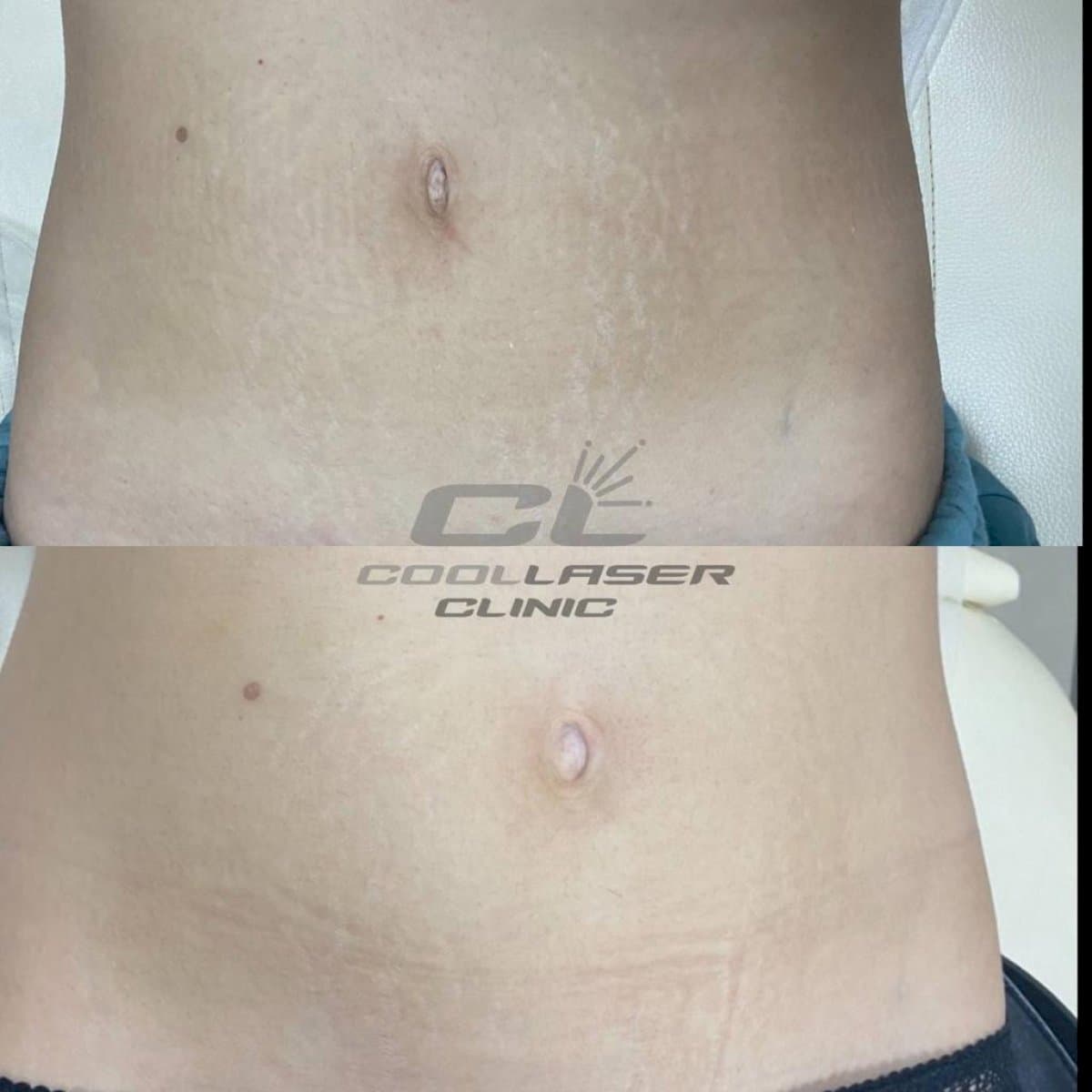laser skin resurfacing for stretch marks
