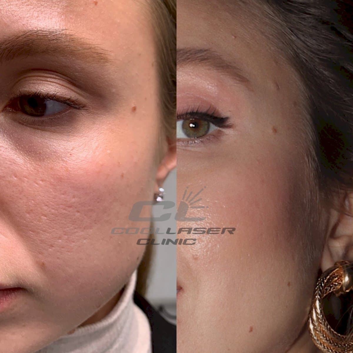 acne scar treatment