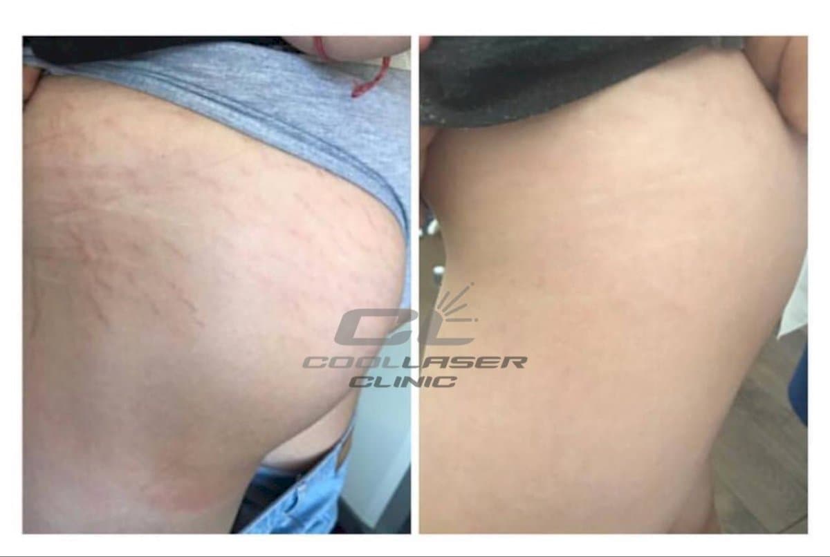 laser skin resurfacing