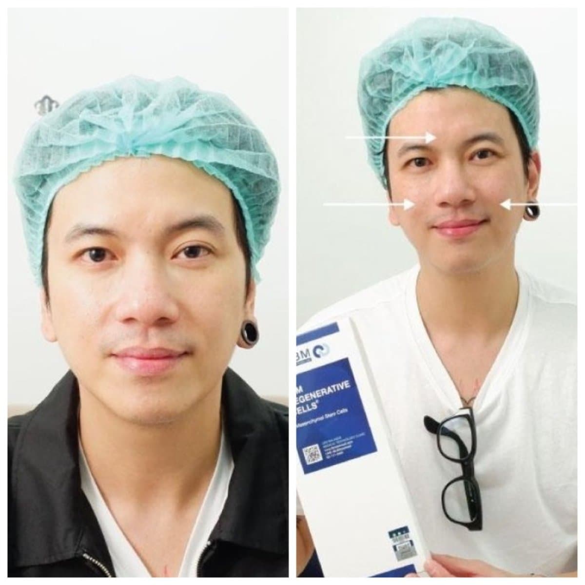 stem cell therapy facial rejuvenation