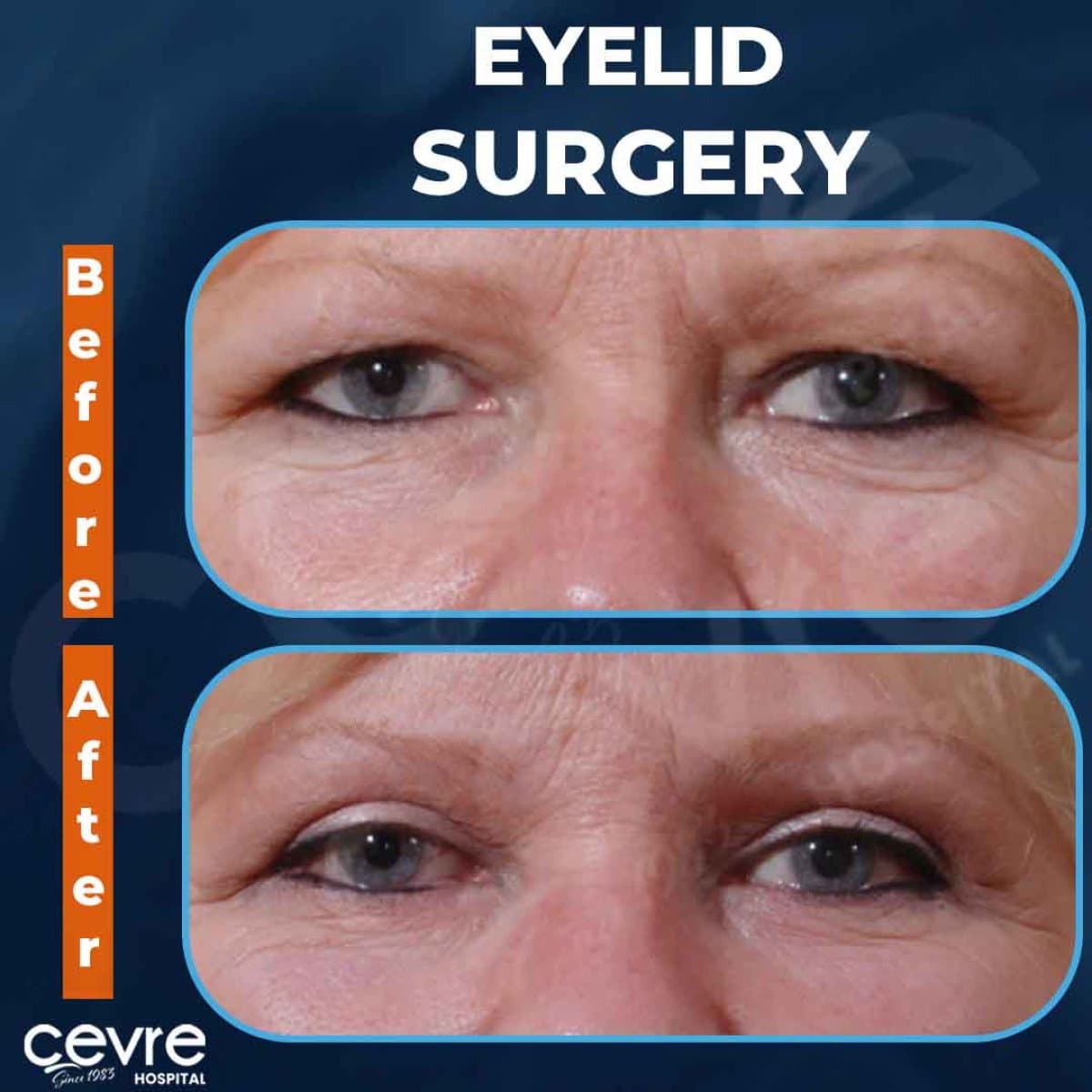 blepharoplasty