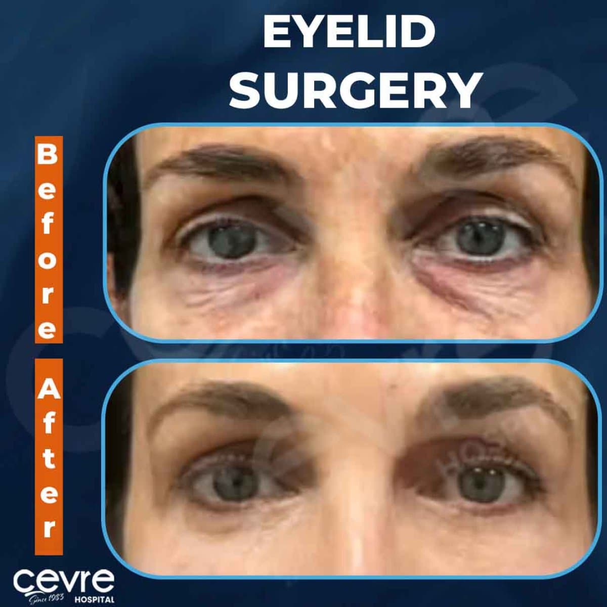 blepharoplasty