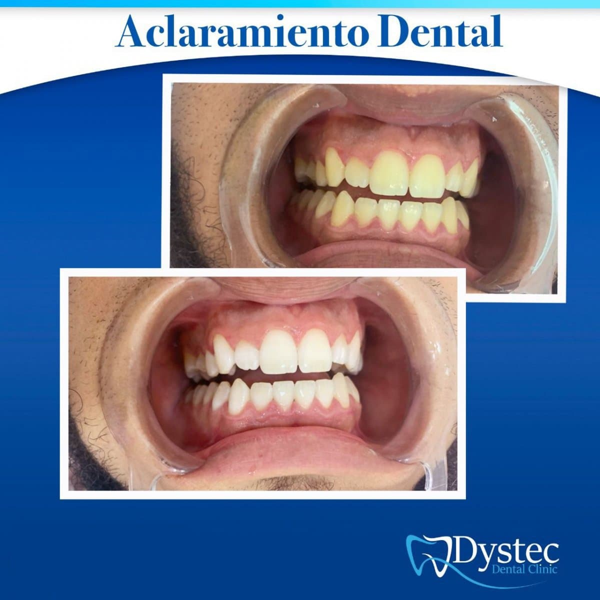 tooth whitening