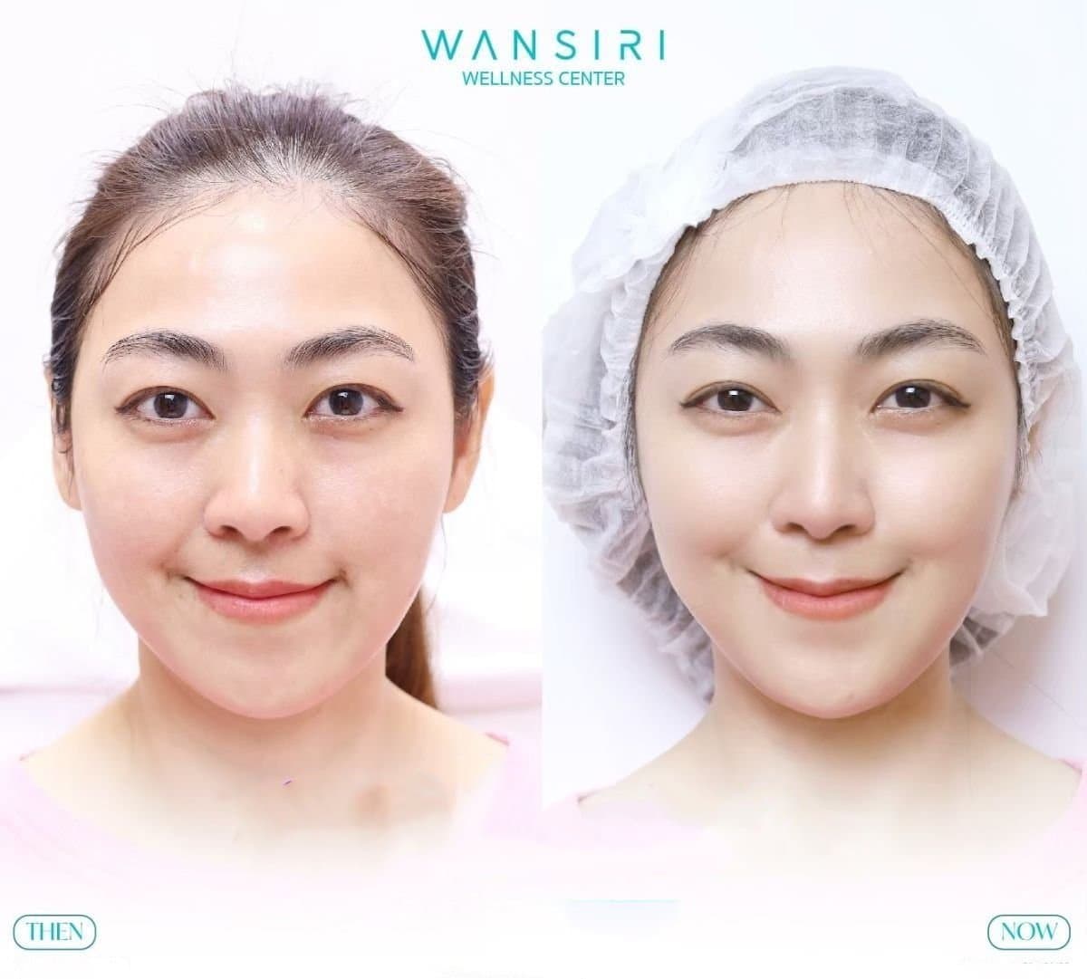 acne scar treatment