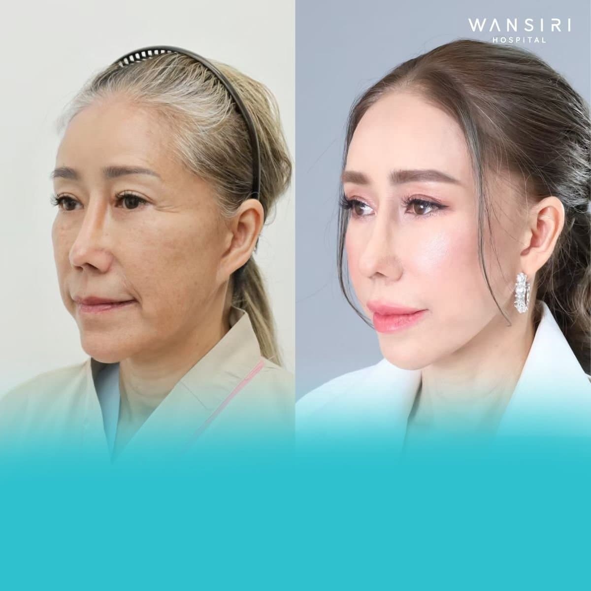 Ultherapy