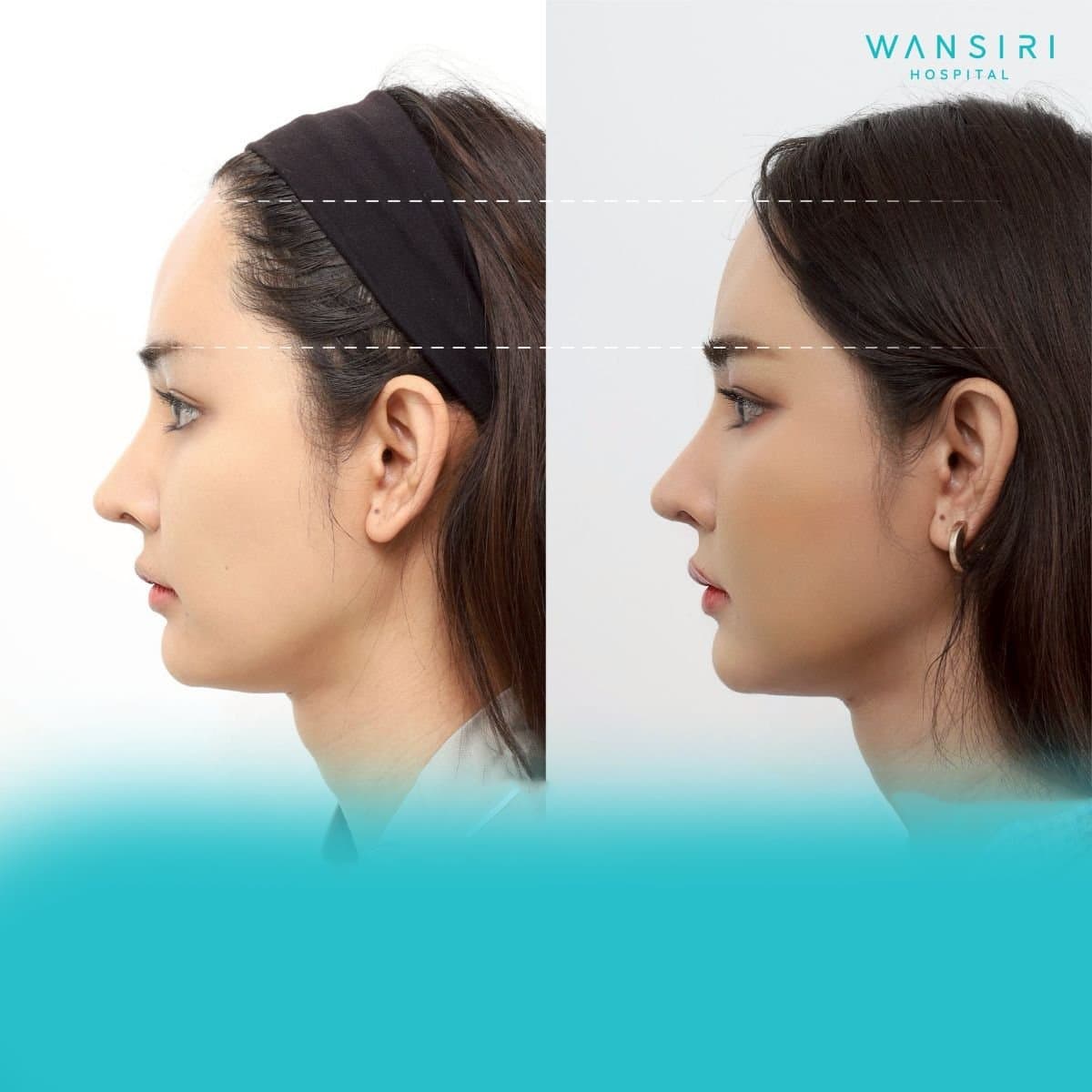 facial fat transfer