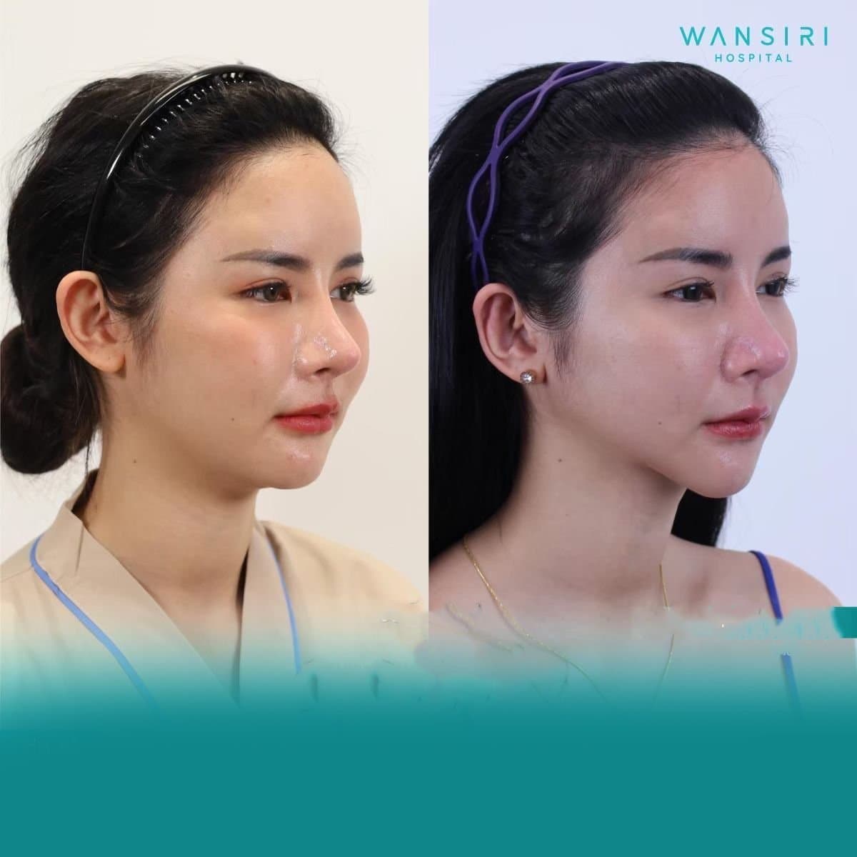 chin liposuction