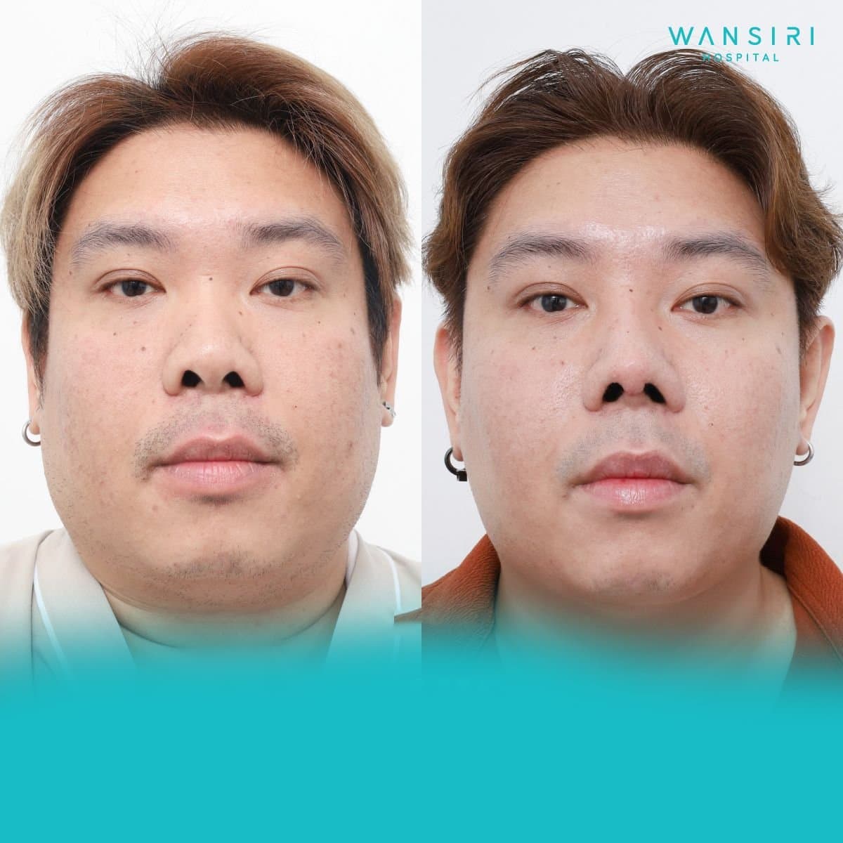 chin liposuction