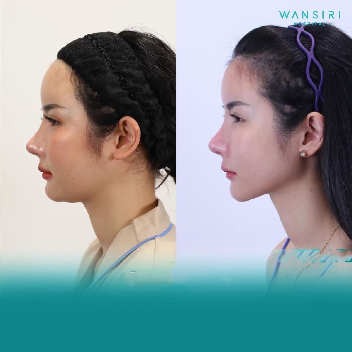 chin liposuction