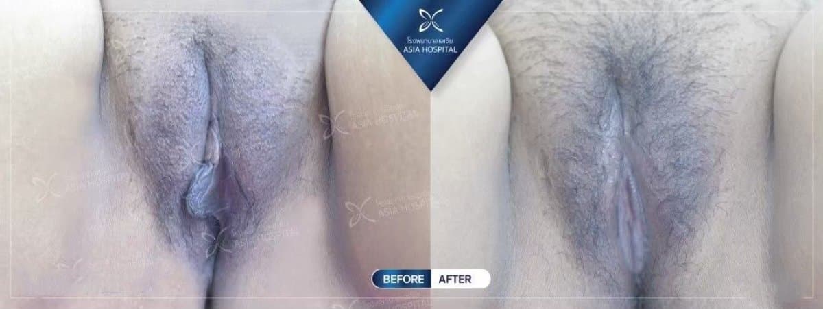 labiaplasty
