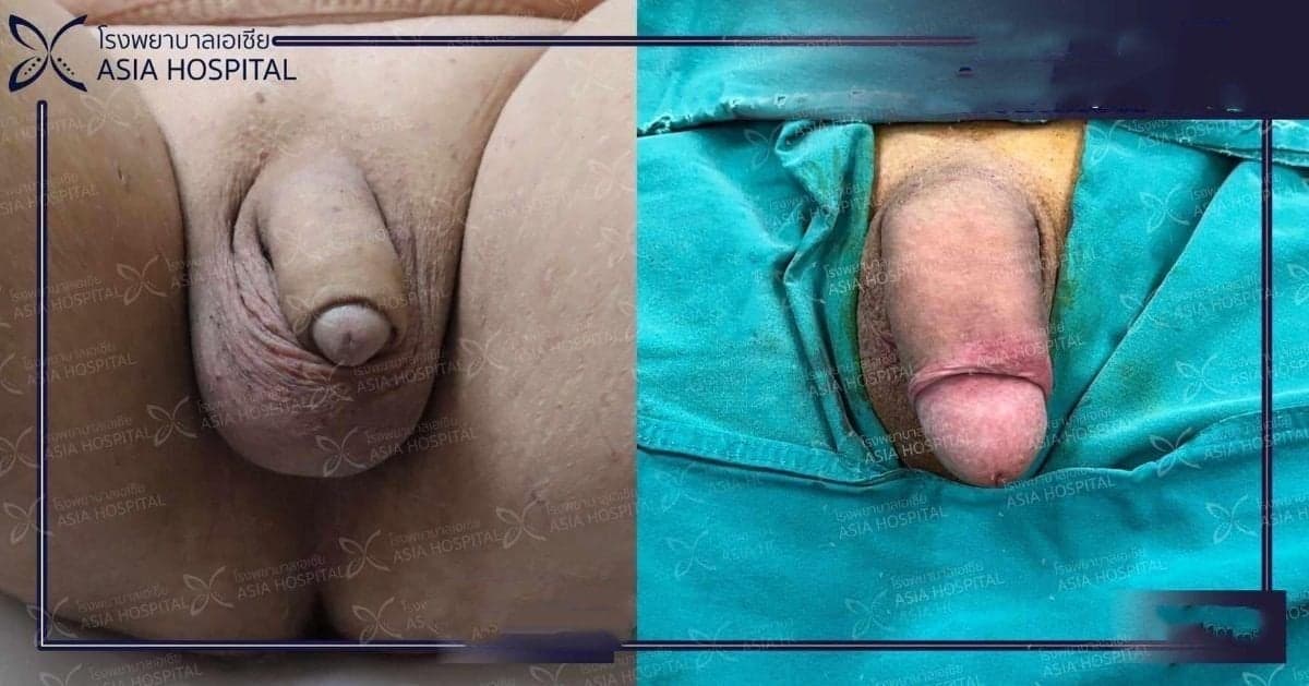 penile implant surgery