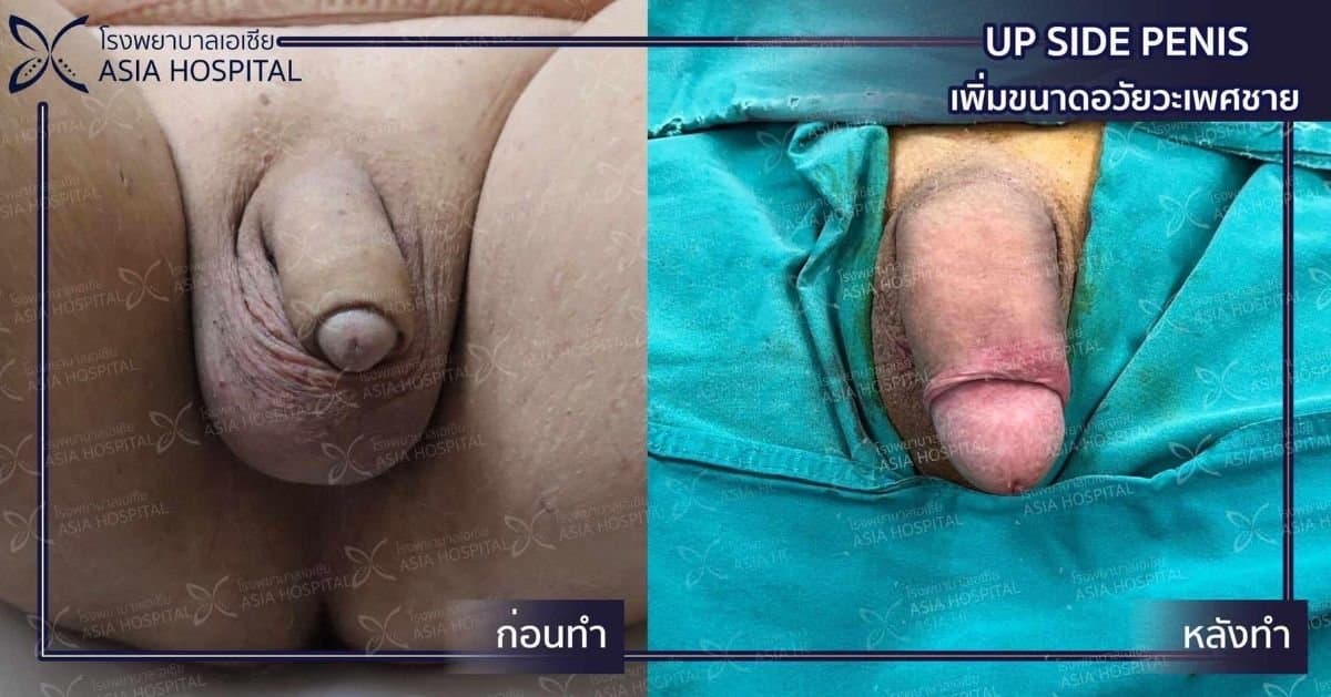 penis enlargement