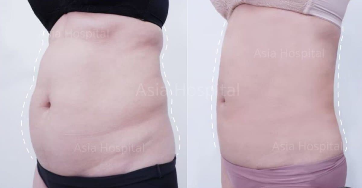 abdominal liposuction